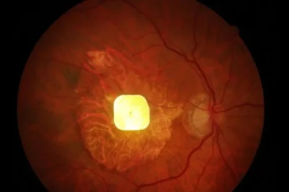 AMD Heilung Solar- Implantat KI Blinde wieder lesen